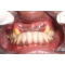 Biggest Dental Fraud ever seen - Money minded doctor pulled 4 upper front teeth