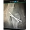 BLIND SURGERY COMPROMISING HIP BONE